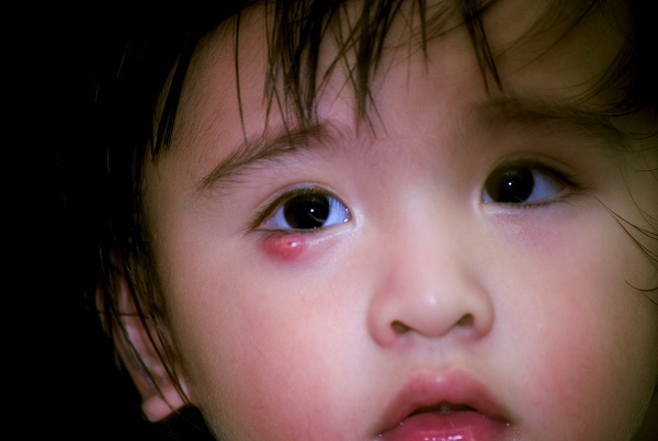 cách chữa lẹo mắt ở trẻ em