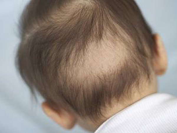 Rụng tóc vành khăn ở trẻ sơ sinh